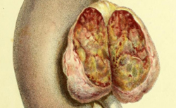 ADDISON, Thomas (1793-1860) On the Constitutional and Local Effects of Disease of the Supra-renal Capsules